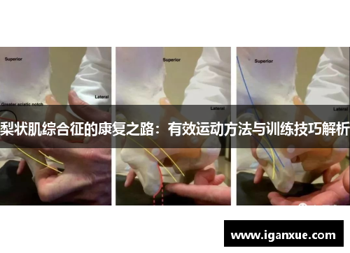 梨状肌综合征的康复之路：有效运动方法与训练技巧解析